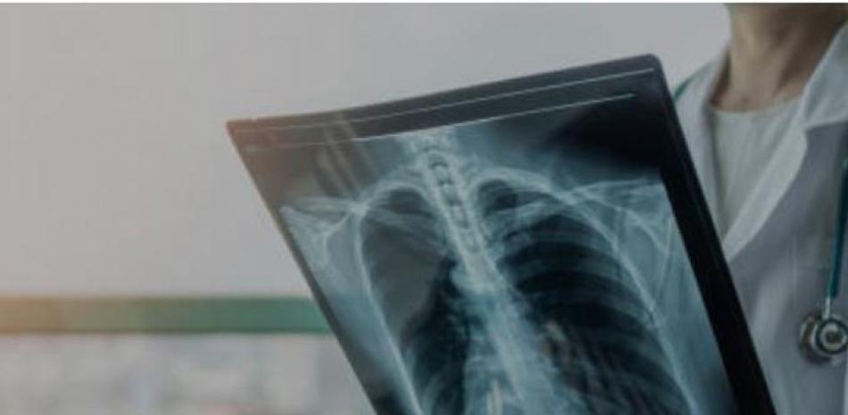 Radiografía de pulmón. Imagen ilustrativa. Archivo / LD