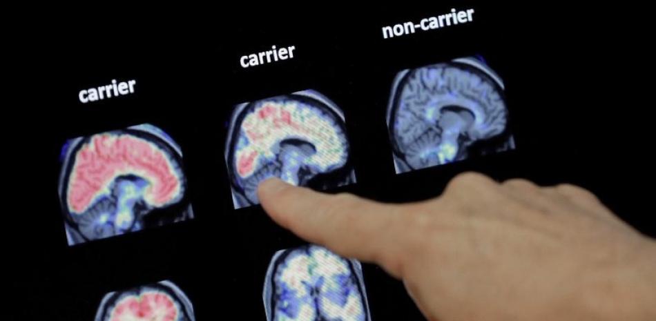 En foto del 14 de agosto de 2018, un médico observa un escáner cerebral PET en el Instituto Banner Alzheimers en Phoenix, California. AP/