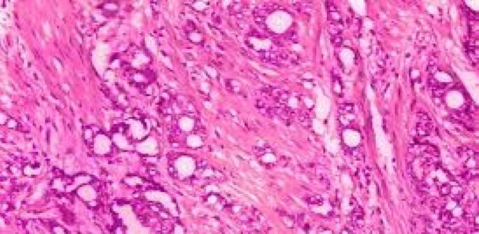 Esta imagen tomada con microscopio y facilitada por los Centros para el Control y la Prevención de las Enfermedades muestra cambios en las células, en un indicio de adenocarcinoma en una próstata. Foto: AP.