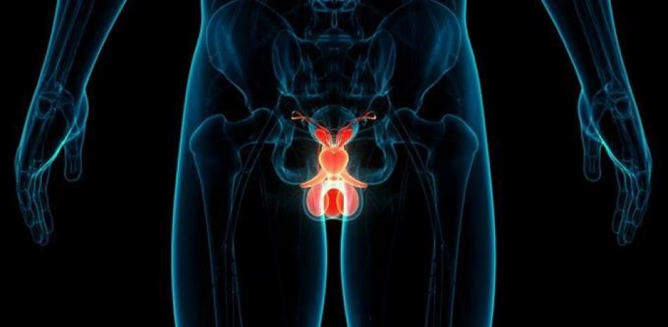 Imagen ilustrativa cáncer de próstata. Fuente: Listín Diario.