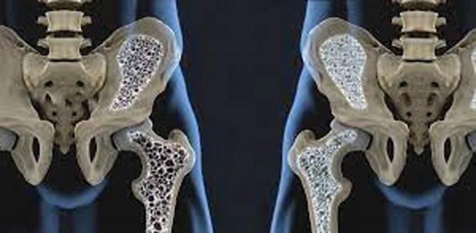 Osteoporosis.