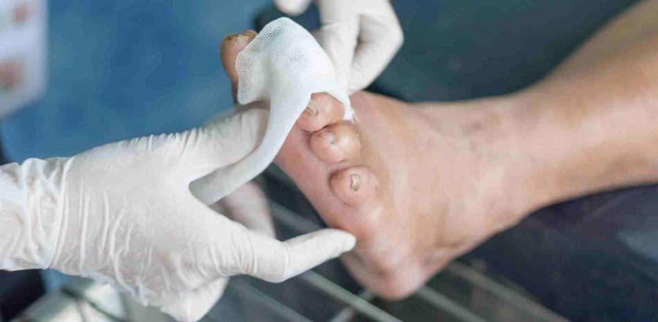 Los especialistas sugieren mantener los pies secos y tener cuidado al cortar las uñas.