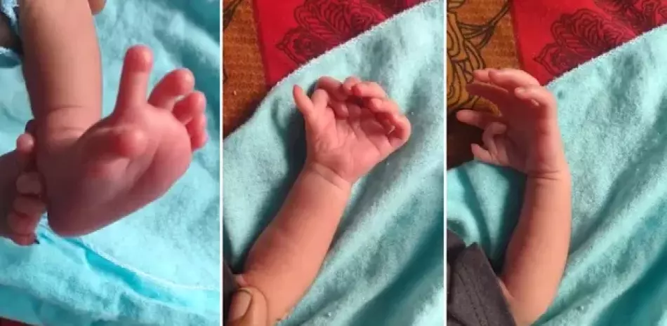 Imagen publicada en redes sociales de las extremidades de la bebé que nació con 26 dedos