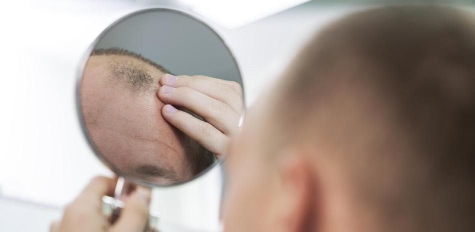 Algunos hombres se rapan para disimular su alopecia.