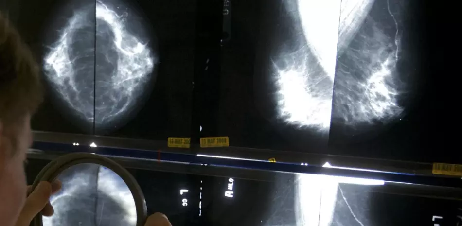 Un radiólogo usa una lupa para verificar mamografías en busca de cáncer de mama en Los Ángeles, 6 de mayo de 2010. Actualmente se recomiendan mamografías anuales de forma indefinida para las sobrevivientes de cáncer de mama en muchos países, incluido Estados Unidos. Ahora, un gran estudio británico descubre que las pruebas de detección menos frecuentes son igual de buenas. Los hallazgos se discutieron el viernes 8 de diciembre de 2023 en el Simposio sobre cáncer de mama de San Antonio.