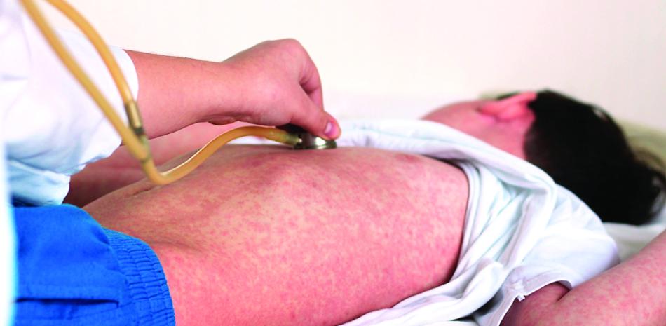 El último caso autóctono de sarampión en el país se detectó en el 2021.