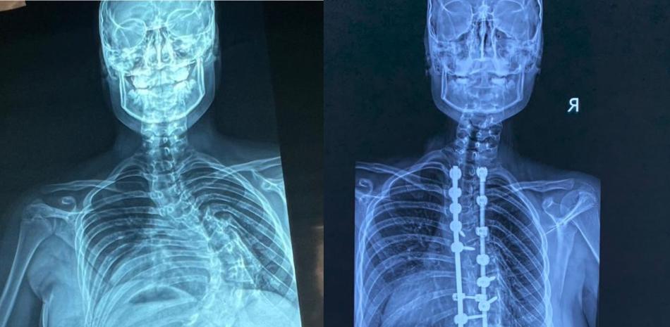 Más de 350 cirugías de corrección de deformidades de columna