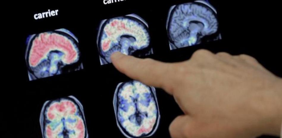 Implante cerebral devuelve el habla a un paciente con parálisis grave desde su casa