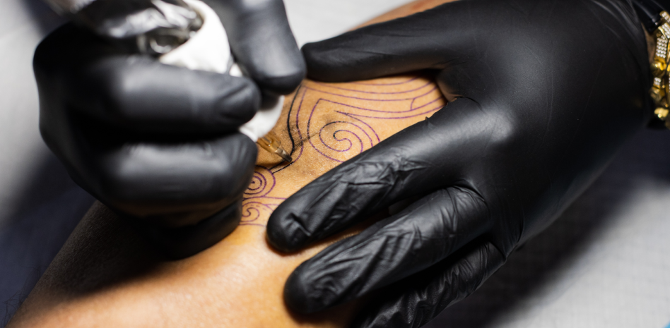 La radioterapia guiada por superficie permite evitar los tatuajes permanentes en pacientes de cáncer