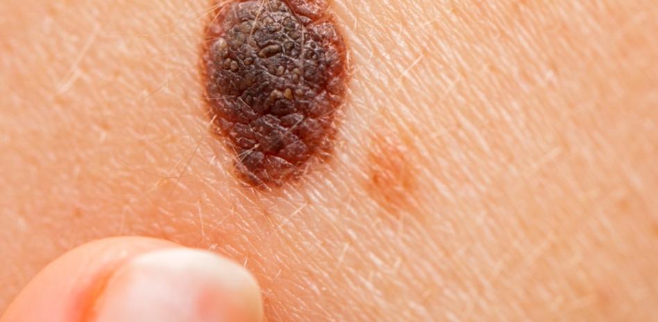 Melanoma maligno: el cáncer que en silencio va afectando la piel