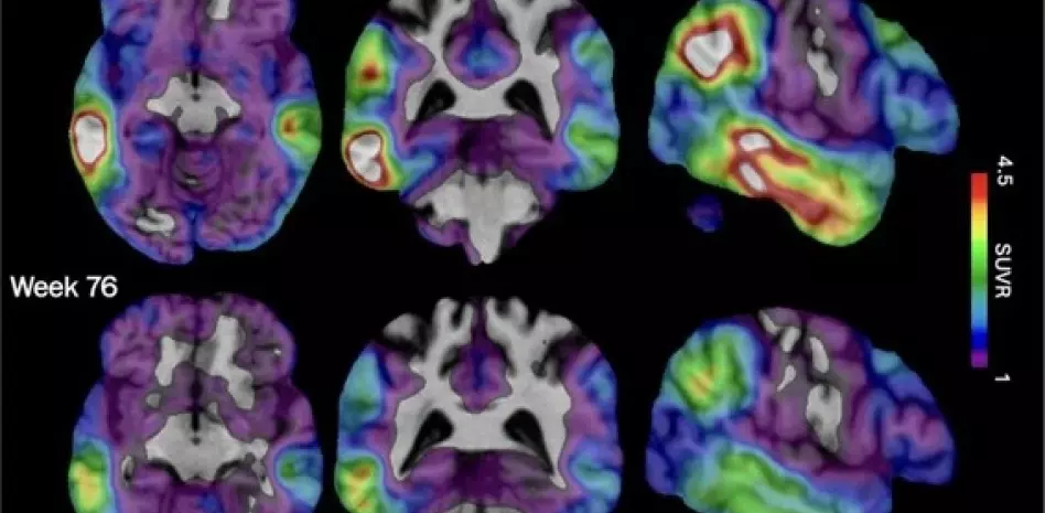 Investigadores buscan combatir el Alzheimer con fármaco experimental