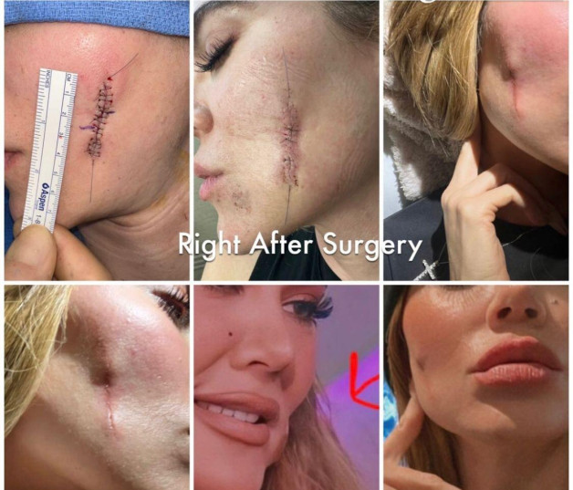 Khloé Kardashian muestra su cicatriz tras extirparse cáncer