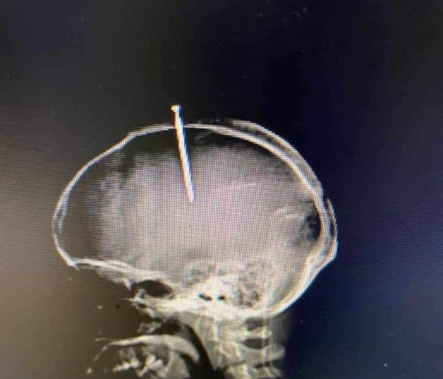 Radiografía donde se observa el clavo dentro de la cabezal del hombre. / Foto: Edgar Lantigua