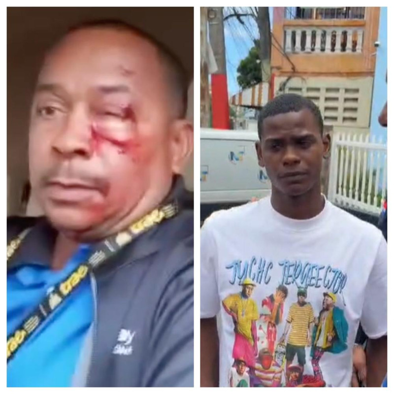 Henry González, conductor del bus de TRAE, resultó con múltiples moretones en el rostro tras ser herido por una turba de motoristas, dentro de los que se encontraba “Negro Malo”, quien se entregó a las autoridades