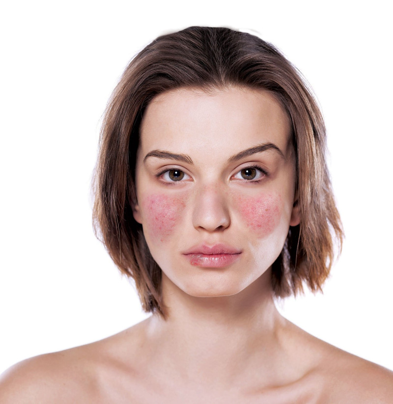 Lupus en el rostro. Foto fuente externa.