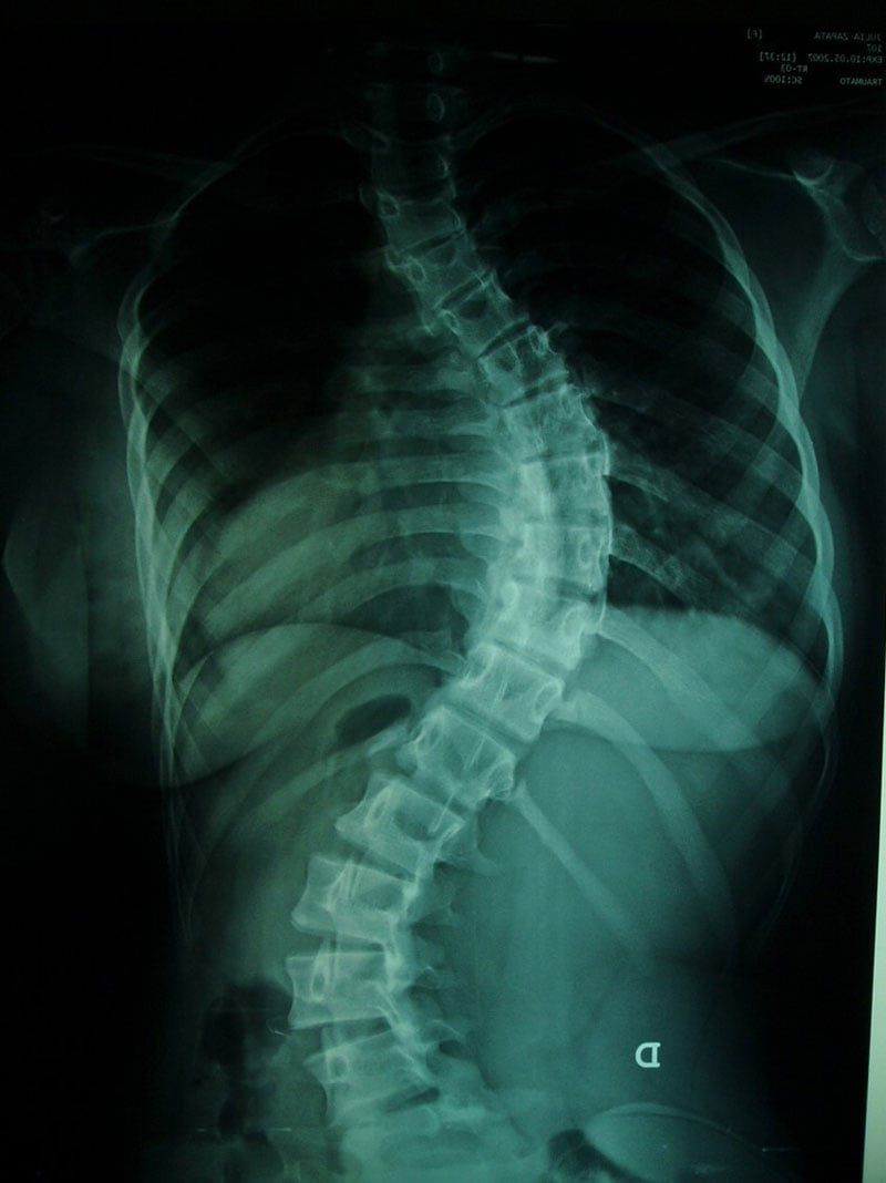 Radiografía de columna lumbar, frente y perfil. Se advierte en las