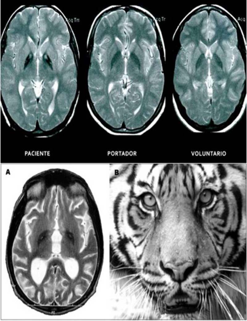 El resultado positivo del PKAN en una resonancia magnética se asemeja a los ojos de un Tigre.