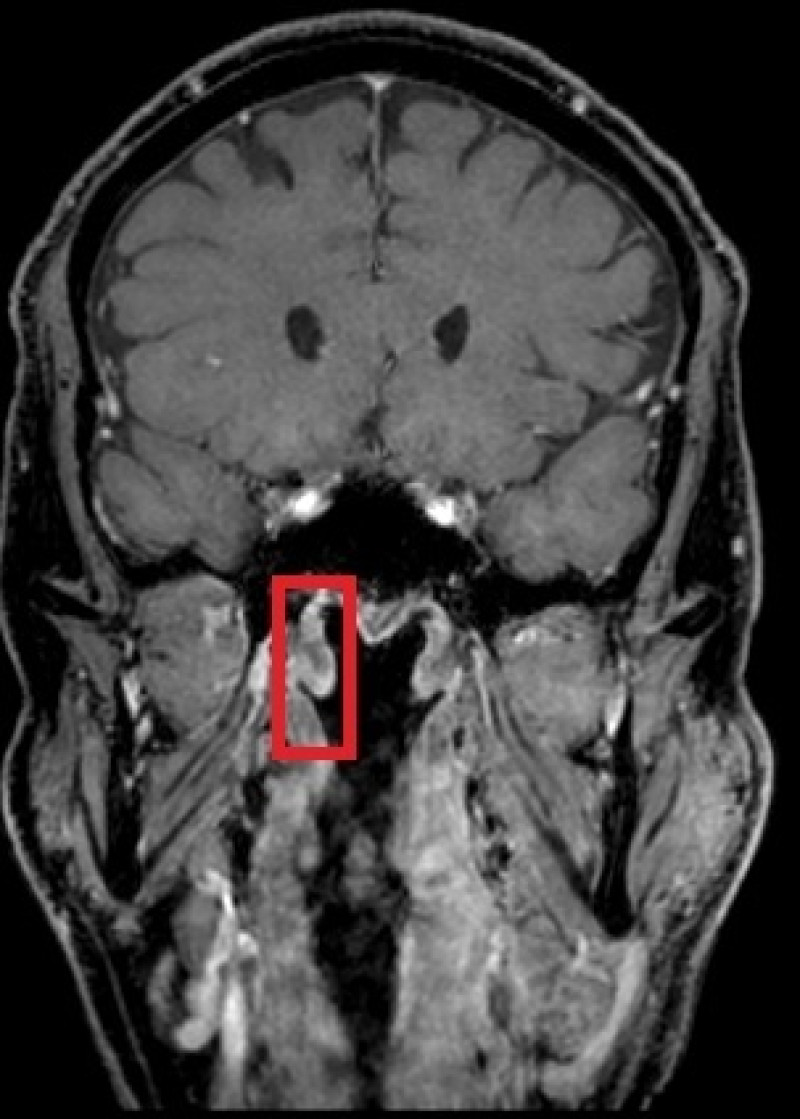 Imagen obtenida mediante RMI (por resonancia magnética) de la cabeza de uno de los pacientes, con las glándulas recién descubiertas dentro de un recuadro en rojo. Netherlands Cancer Institute (NKI) / EFE
