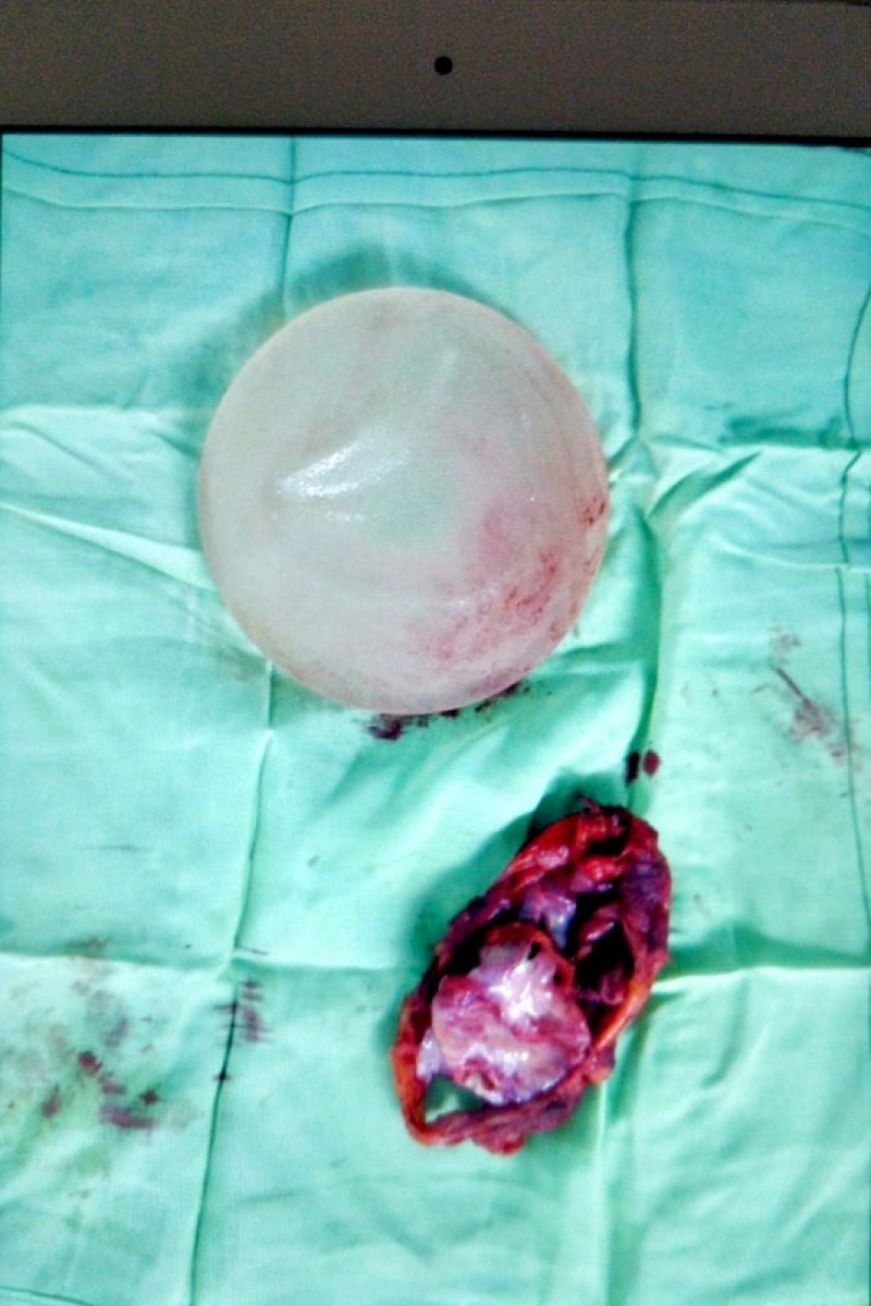 Uno de los implantes de Karen Báez Noboa estaba cubierto de una capa de tejido fibroso.