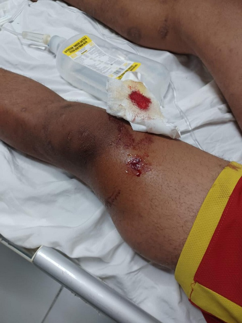 Herido de bala en pierna izquierda del menor de edad, fuente externa.