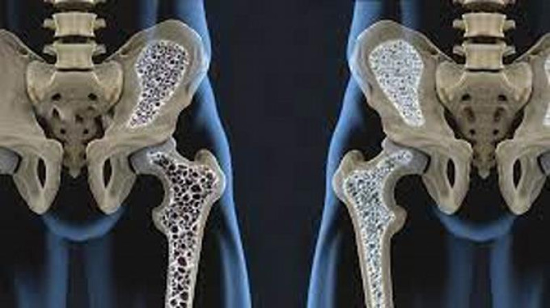 Osteoporosis.