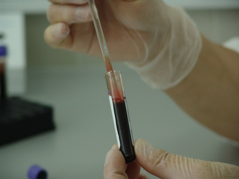 Foto de muestra de sangre de paciente con VIH.