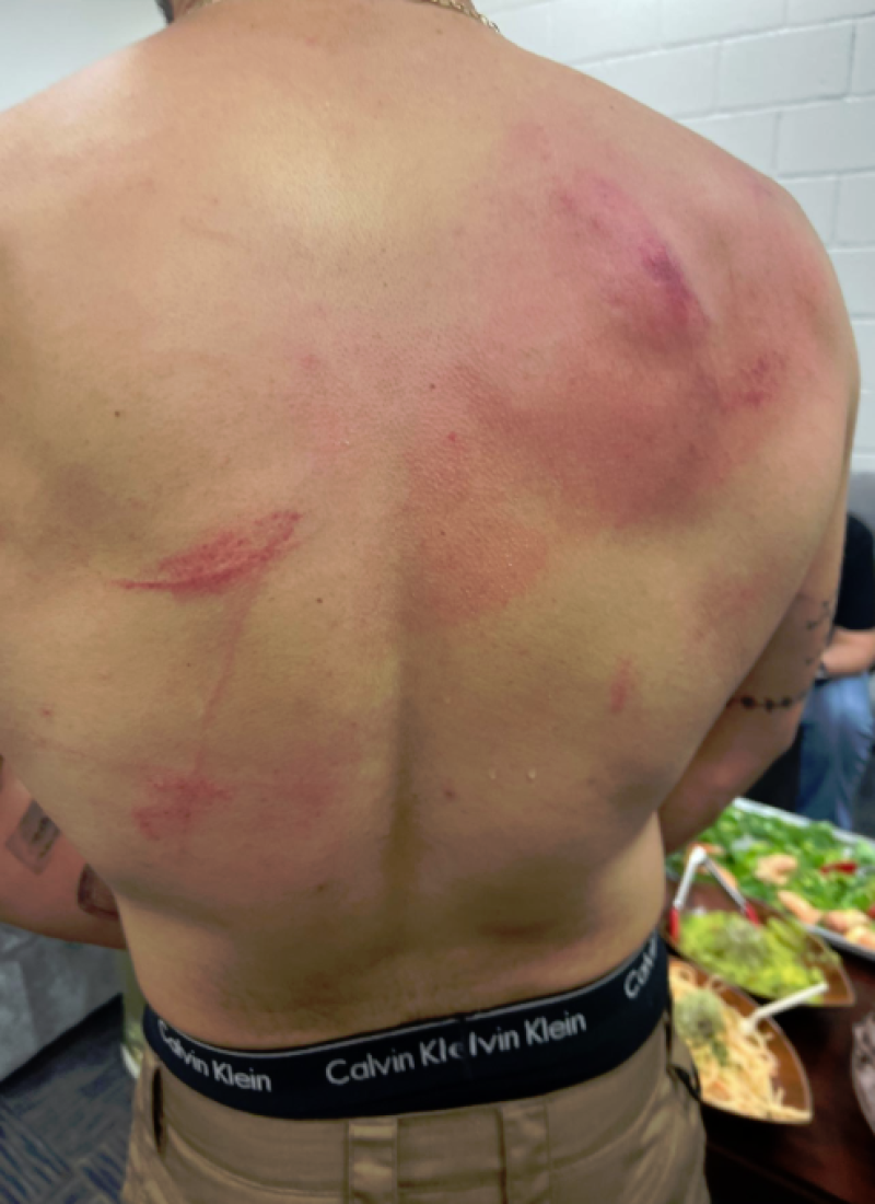Espalda del artista urbano Bad Bunny con arañazos tras pelea en la WWE.