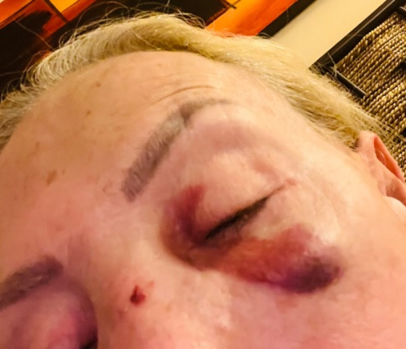 Laura Bozzo se golpeó la cara tras caída