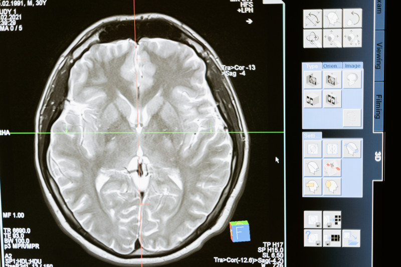 Cerebro humano.