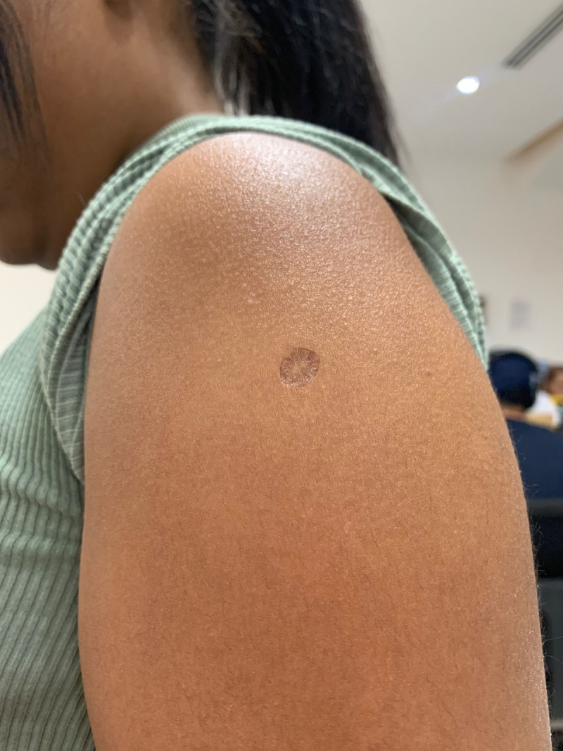 Cicatriz de la vacuna contra la tuberculosis