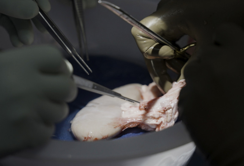 Cirujanos de Langone Health de la NYU se preparan para trasplantar un riñón de cerdo a un hombre