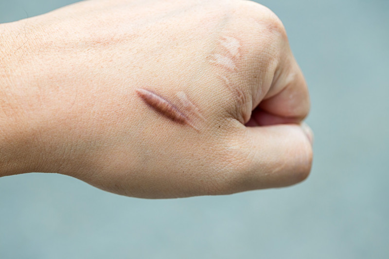El queloide es un crecimiento anormal de una cicatriz, luego de una lesión en la piel.