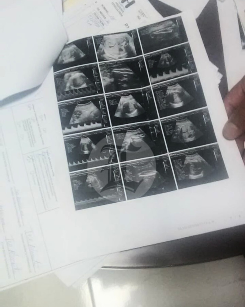 Fotografía muestra una de las Sonografías de los mellizos que esperaban la pareja de esposos que denunciaron que uno de los bebés les fue hurtado.