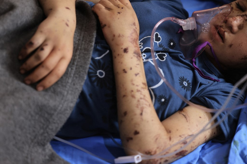 Layan al-Baz, amputada de trece años, recibe tratamiento en el hospital Nasser de Khan Yunis, en el sur de la Franja de Gaza, el 31 de octubre de 2023.
