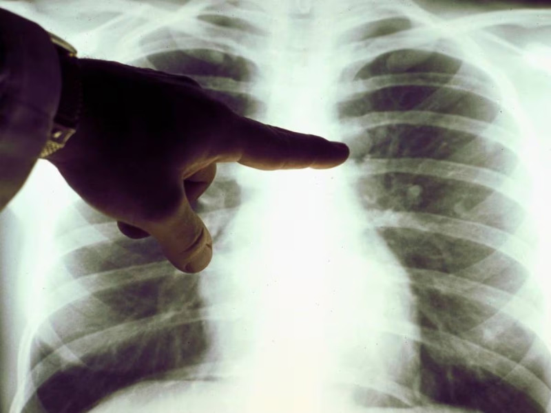 El cáncer de pulmón es uno de los más comunes.