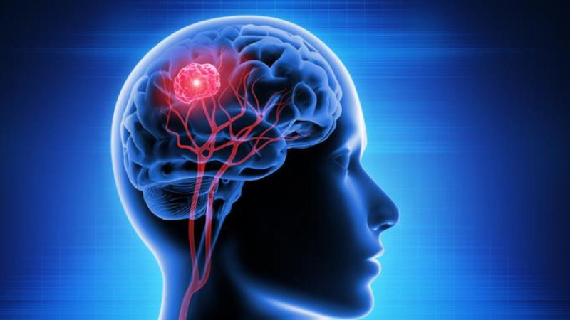 Una nueva herramienta basada en IA permitirá mejorar el diagnóstico de tumores cerebrales