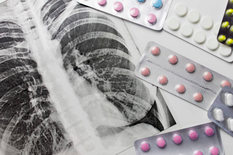 Imagen ilustrativa de tratamiento para la tuberculosis