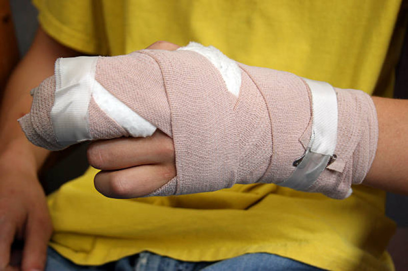 Un niño con lesiones en una mano.