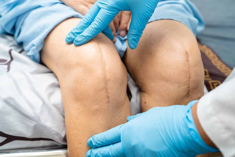 La mayor cantidad de prótesis son para rodilla y cadera.