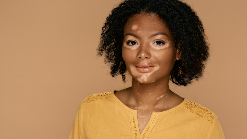 Mujer con vitiligo