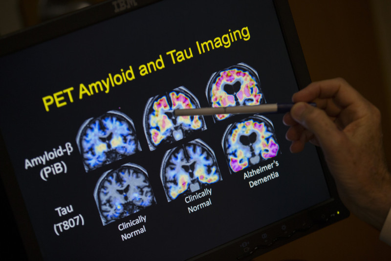Un médico señala imágenes de un escáner cerebral dentro de un estudio sobre el Alzheimer en el hospital de la Universidad de Georgetown, el martes 19 de mayo de 2015 en Washington