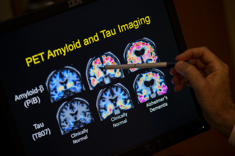 Un médico señala imágenes de un escáner cerebral dentro de un estudio sobre el Alzheimer en la Universidad de Georgetown, el19 de mayo de 2015 en Washington.