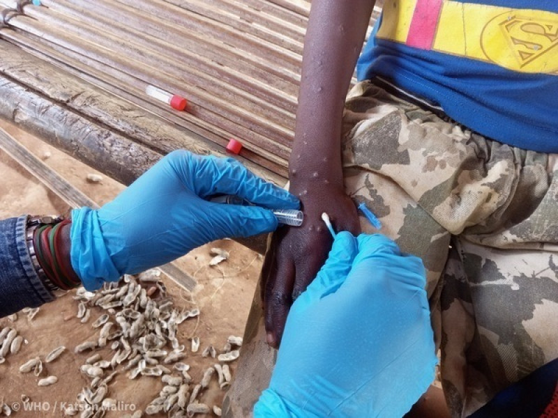 Funcionarios de la OMS y del Ministerio de Salud toman una muestra de un paciente con mpox en Mongala, República Democrática del Congo, el 25 de marzo de 2023.