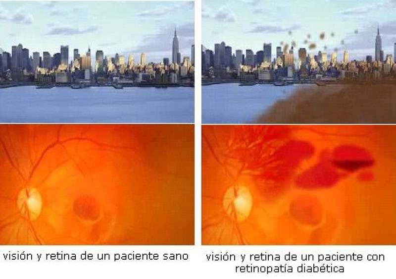 Visión y retina de un paciente sano vs retinopatía diabética