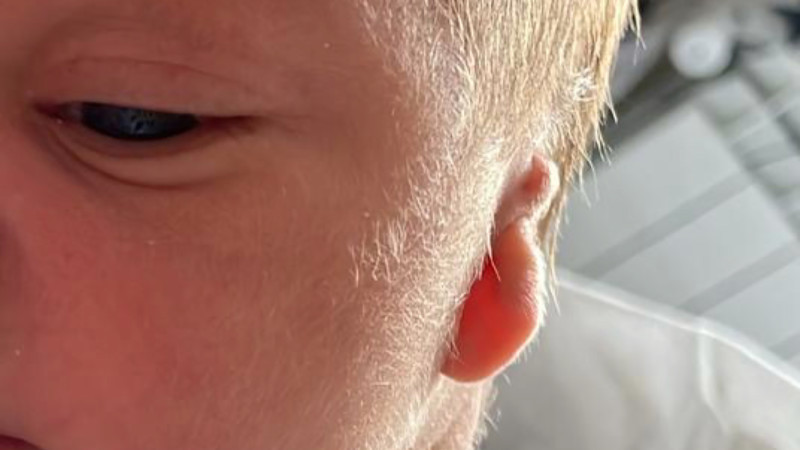 microtia
