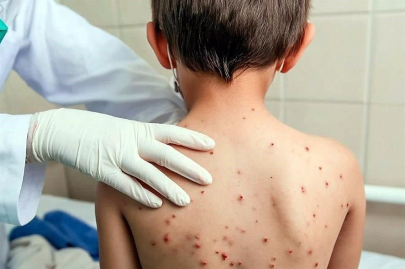 El sarampión es altamente contagioso y una sola persona puede transmitirlo a hasta 18 personas más.