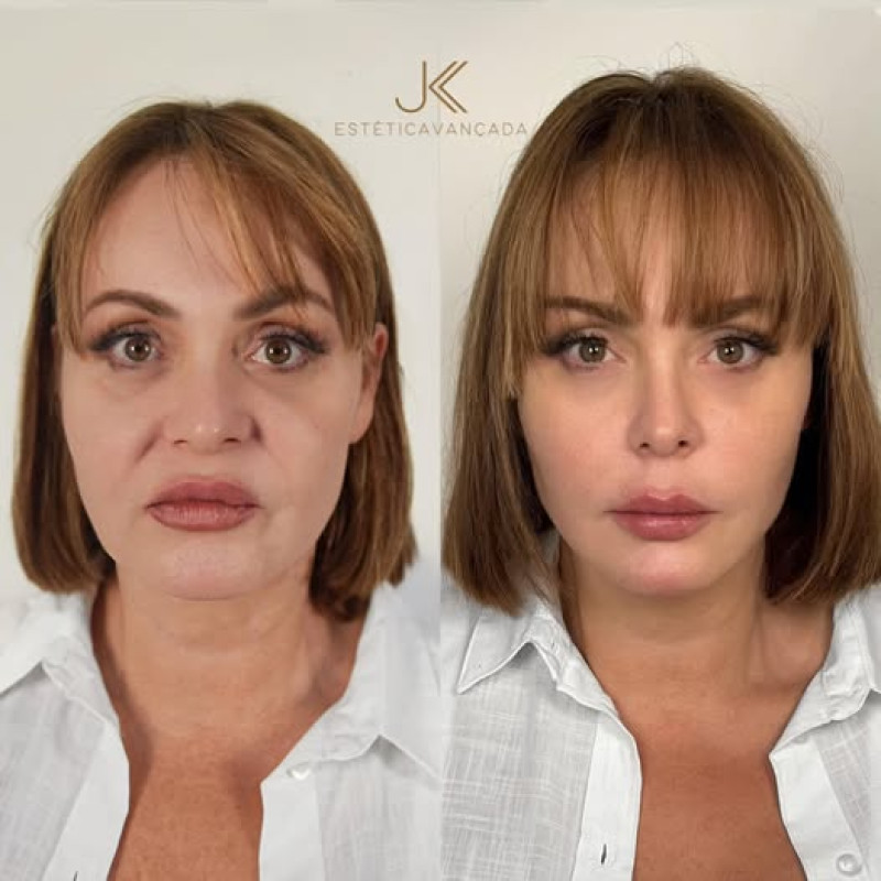 Gaby Spanic tras someterse a procedimiento de rejuvenecimiento facial.