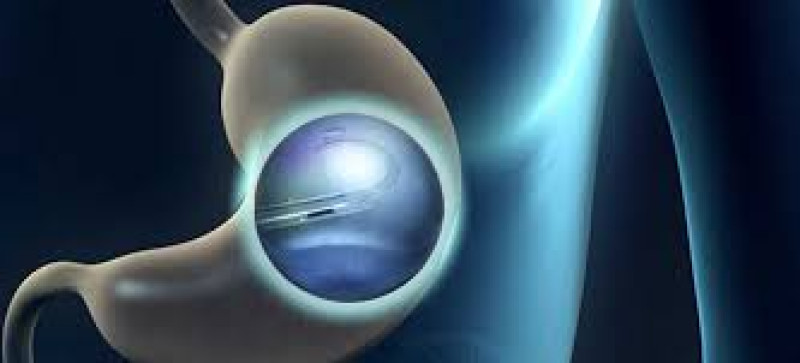 Imagen representativa de endoscopia bariátrica.