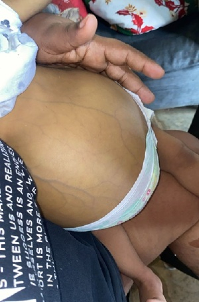 Condición en la que se encuentra la niña Jaronny Rodríguez, requiere de trasplante urgente