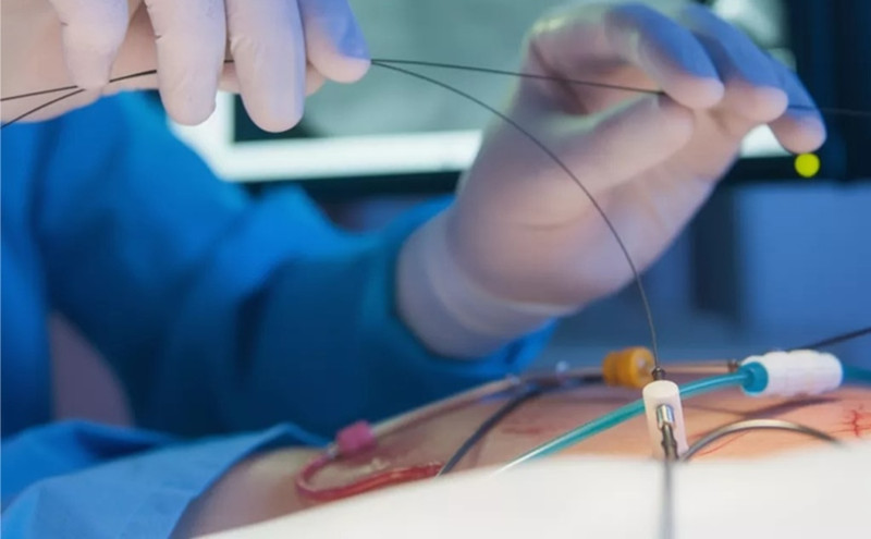 La mayoría de las angioplastias se realizan en pacientes afiliados al régimen subsidiado de salud.